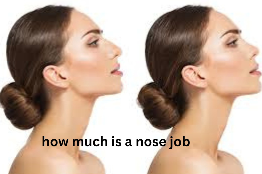how much is a nose job